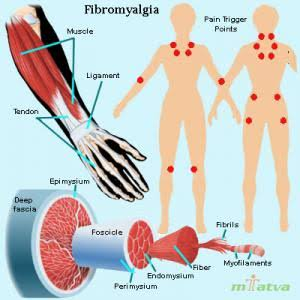 Fibromyalgia